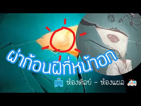 ผ่าก้อนฝีที่หน้าอก