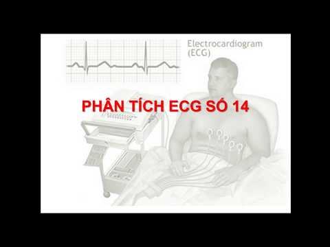 Video ECG 14 Nhồi máu cơ tim và block nhánh trái - youtube