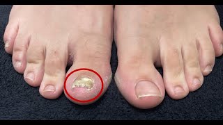 Thick and Discolored Nail Makes a Dramatic Recovery - Dr. Lloyd&#39;s Laser Treatment for Fungal Nails