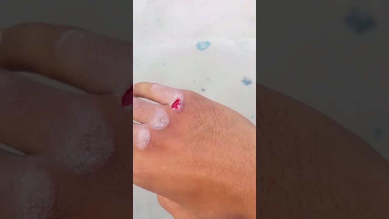 Knuckles drill:Day 10 Punching on cement wall 🥊🥊🥊👊👊👊 