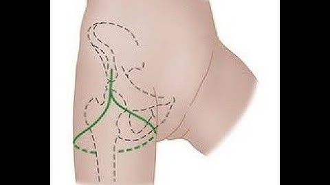Hip Disarticulation
