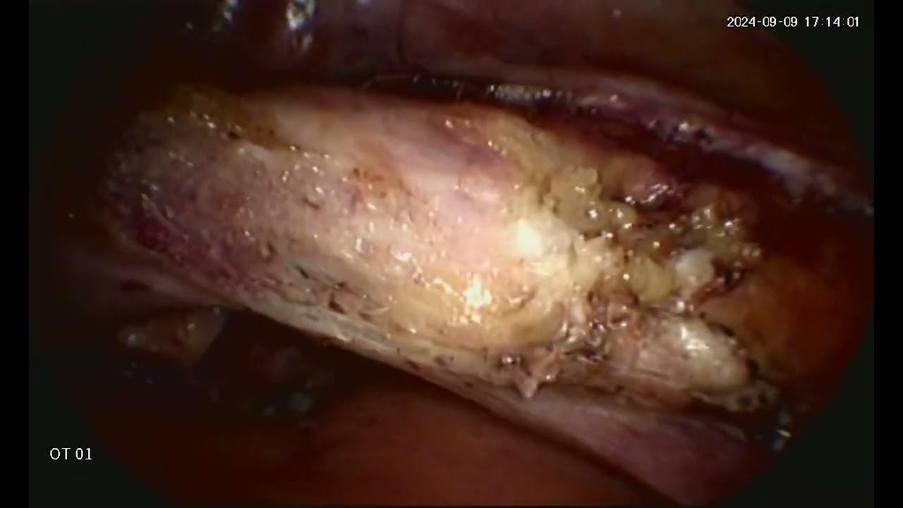 Laparoscopic Hysterectomy with Bilateral Salpingectomy YouTube