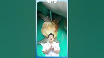 Sự Thật Về Con Sâu Trong Răng | Nha Khoa Minh Châu