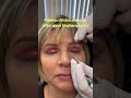 Painless stitches removal after upper blepharoplasty