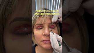Painless stitches removal after upper blepharoplasty