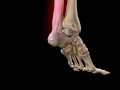 Achilles Tendon Rupture | Complete Anatomy