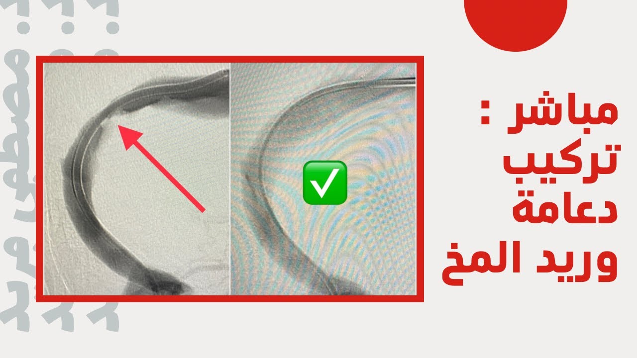 مباشر من عمليات القسطرة المخية : تركيب دعامة بوريد المخ لعلاج ارتفاع ضغط المخ و ارتشاح العصب البصري