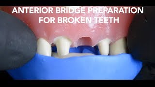 Dental Bridge Preparation After Tooth Extraction
