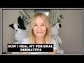 PERIORAL DERMATITIS - HOW I TREAT MY SKIN FLARE UPS