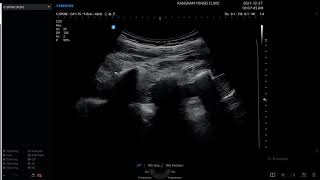 초음파 유도하 허리 경막외 신경치료(L4,5) 및 기립근 통증유발점 주사 twitching response, ultrasound guide epidural block