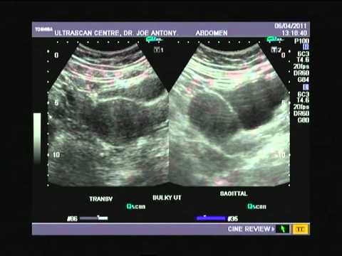 Bulky Uterus Ytube 1a Mpg Youtube