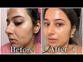 Simple Tretinoin Night Skincare Routine for Acne free Glowing Skin #skincare #skincareroutine