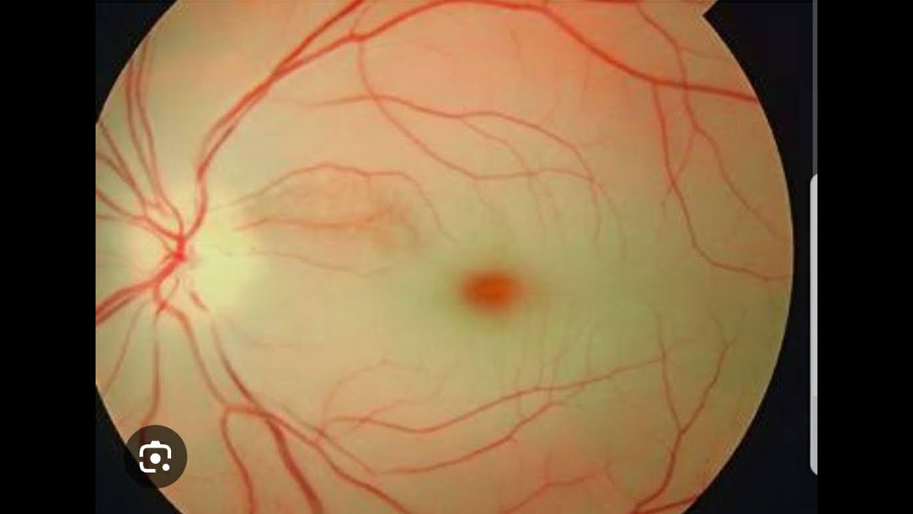 Retinal vascular disease quiz
