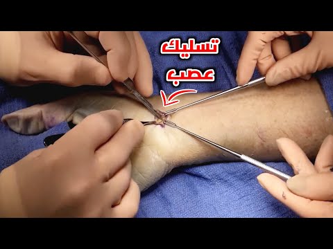 شاهد كيف يتم ازالة الكيس الزلالي من اليد الجانجليون        