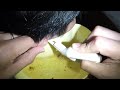 Removing Man&#39;s Earwax by Ear Irrigation