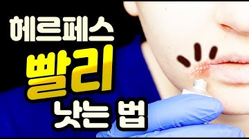 입술 헤르페스 빨리 낫는 법 (입술포진)