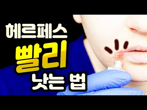 How to Cure Oral Herpes Quickly (Herpes Labialis)