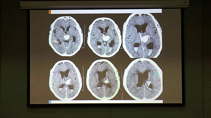 "Hydrocephalus" - Carolyn Carey, MD