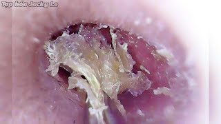 Ear Wax Removal #75: Earwax Is Big, Very Dry And Itchy | Ear Cleaning ASMR