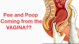 Rectovaginal Fistula: D&N Medical Series