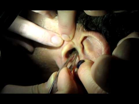 Play Ear Wax Removal Videos 83