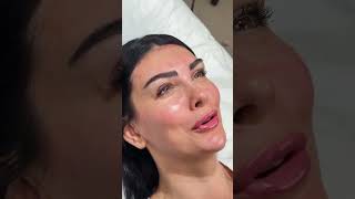 kaş şeklini düzeltmenin en yeni yöntemidir!Kendi saç tellerinizden, tek tek uygulanır ve cerrahi de