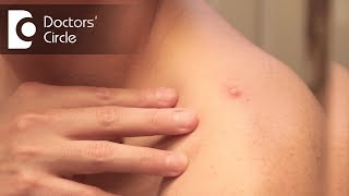 How to manage boils on skin in adults? - Dr. Aruna Prasad
