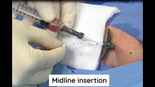 Midline insertion