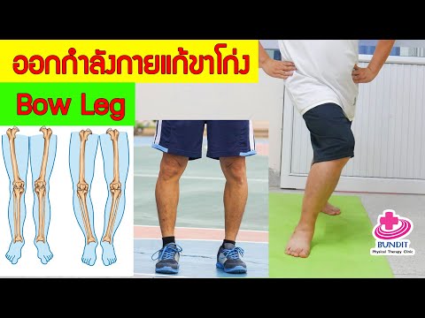 ออกกำลังกายลดอาการเข่าโก่ง ขาโก่ง (Bow Leg)