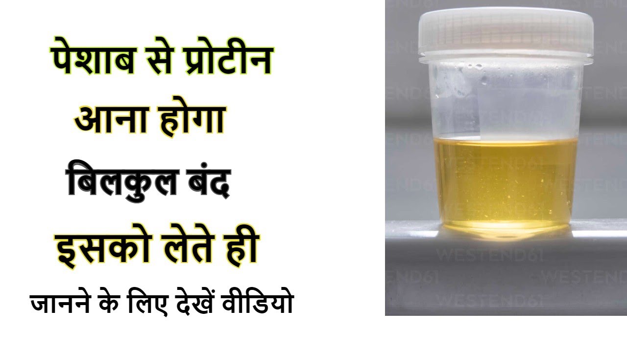 पेशाब में प्रोटीन आने का इलाज Stem cell proteinuria protein in