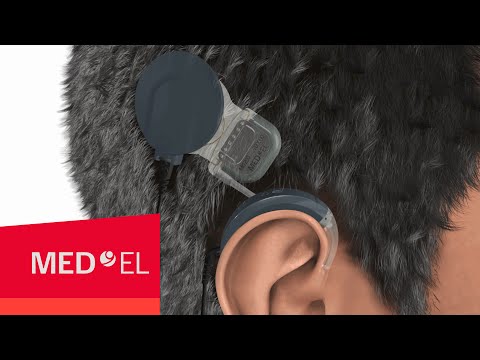 How Do Cochlear Implants Work? The SYNCHRONY Cochlear Implant | MED-EL