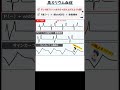 聞き流し1分間心電図『高カリウム血症』　心電図検定4級3級