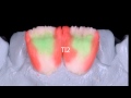 Technique de stratification ZIRPRESS ( Emax Ivoclar)