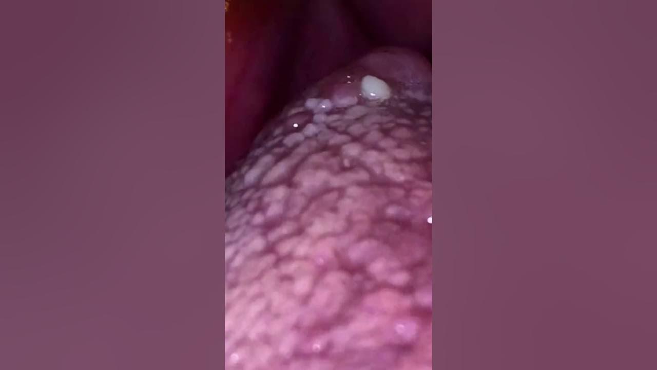 Coughing Up Tonsil Stones YouTube