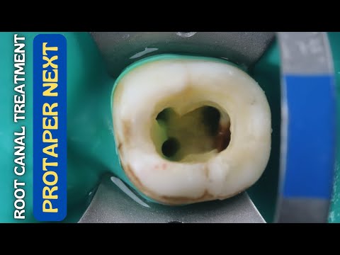 Root Canal Treatment in Mandibular Molar ⚪️ Protaper Next 🔵 Step By Step Demonstration