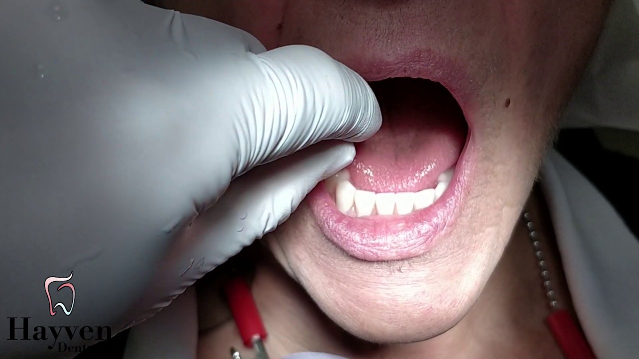 Denture Clinic St. Catharines Denturist, Hayven Dentures, Suction Dentures,...