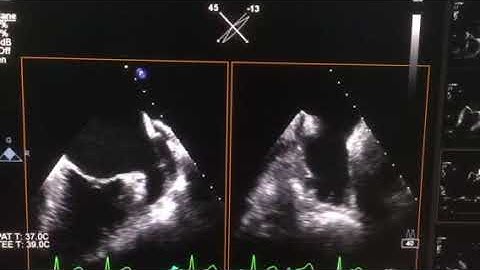 Evaluating left atrial appendage using TEE