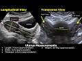 How To Measure Uterus On Ultrasound | Uterine Length, Width, AP Thickness Measurements TA/TVS USG