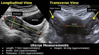 How To Measure Uterus On Ultrasound | Uterine Length, Width, AP Thickness Measurements TA/TVS USG screenshot 1