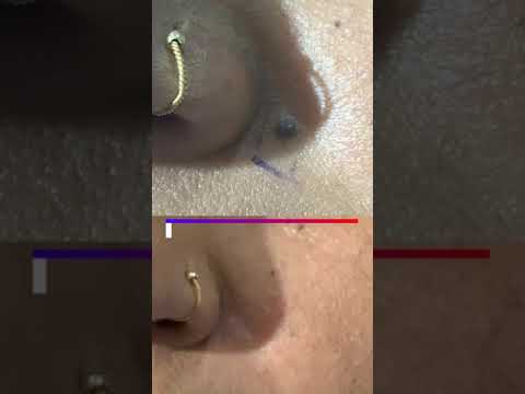 Video: Hoe zich te ontdoen van moedervlekken op uw gezicht (met afbeeldingen)