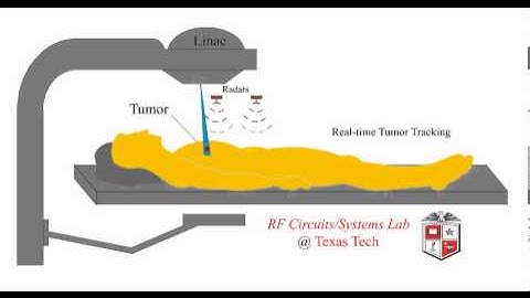 Radiotherapy with Tumor Tracking