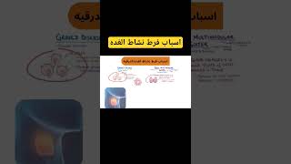 اسباب فرط نشاط الغده  #ahmed_pharmacy #fypシ #viral #الغدة_الدرقية