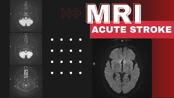 A simplified approach to MRI in acute ischemic stroke