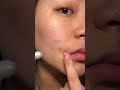 SOS acne calming cream⚠️ #skincare
