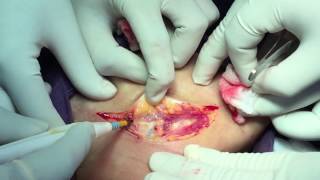 Submandibular gland excision - Dr. Satish Jain - www.skullbase360.in