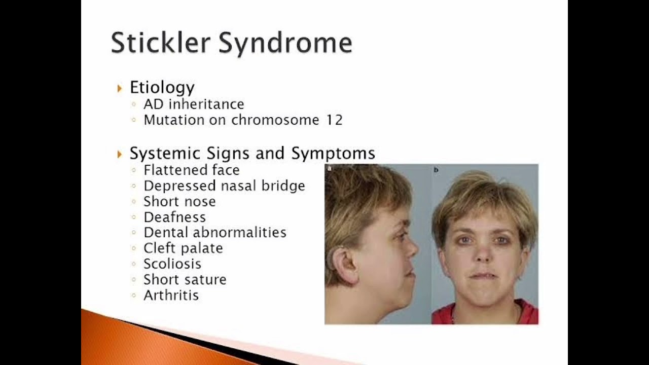 Stickler Syndrome YouTube Stickler Syndrome YouTube