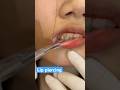 Got A Lip Piercing How S It Feel Share Lippiercing Shorts Fyp Got A Lip Piercing How S It Feel Share Lippiercing Shorts Fyp