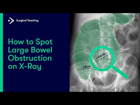 Large Bowel Obstruction | How Do We Diagnose It On Abdominal X-Ray