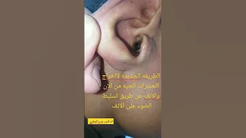 اخراج الحشرات من الاذن والانف 