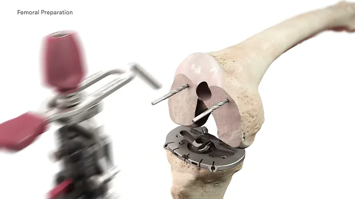 ATTUNE Revision FB Surgical Technique Animation